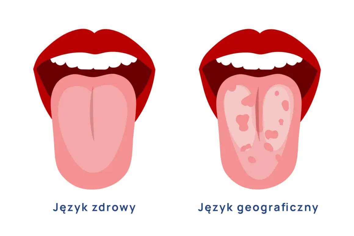 Dwa języki: zdrowy i z plamami, ilustracja porównawcza.