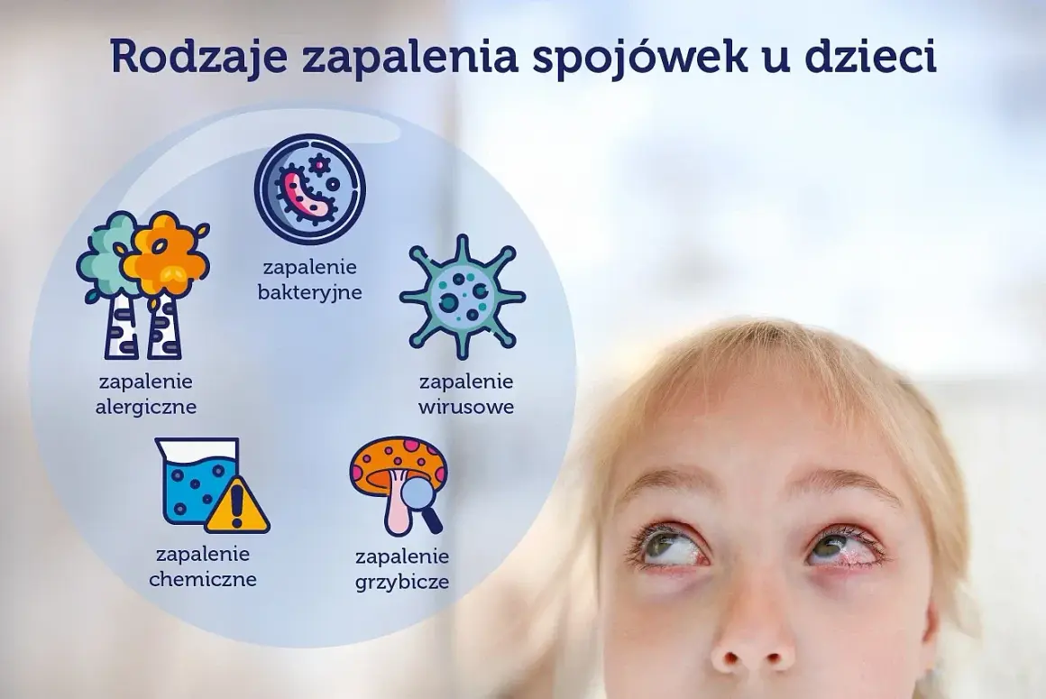 Grafika przedstawia rodzaje zapalenia spojówek u dzieci: alergiczne, bakteryjne, wirusowe, chemiczne i grzybicze. Widoczna jest też część twarzy dziecka z zaczerwienionym okiem.