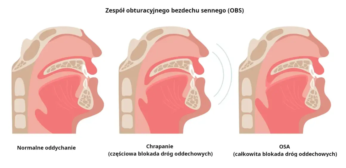 Ilustracja pokazuje przekrój gardła przy normalnym oddychaniu, chrapaniu (częściowa blokada) i bezdechu sennym (OSA, całkowita blokada). Domowe sposoby na bezdech senny mogą pomóc.