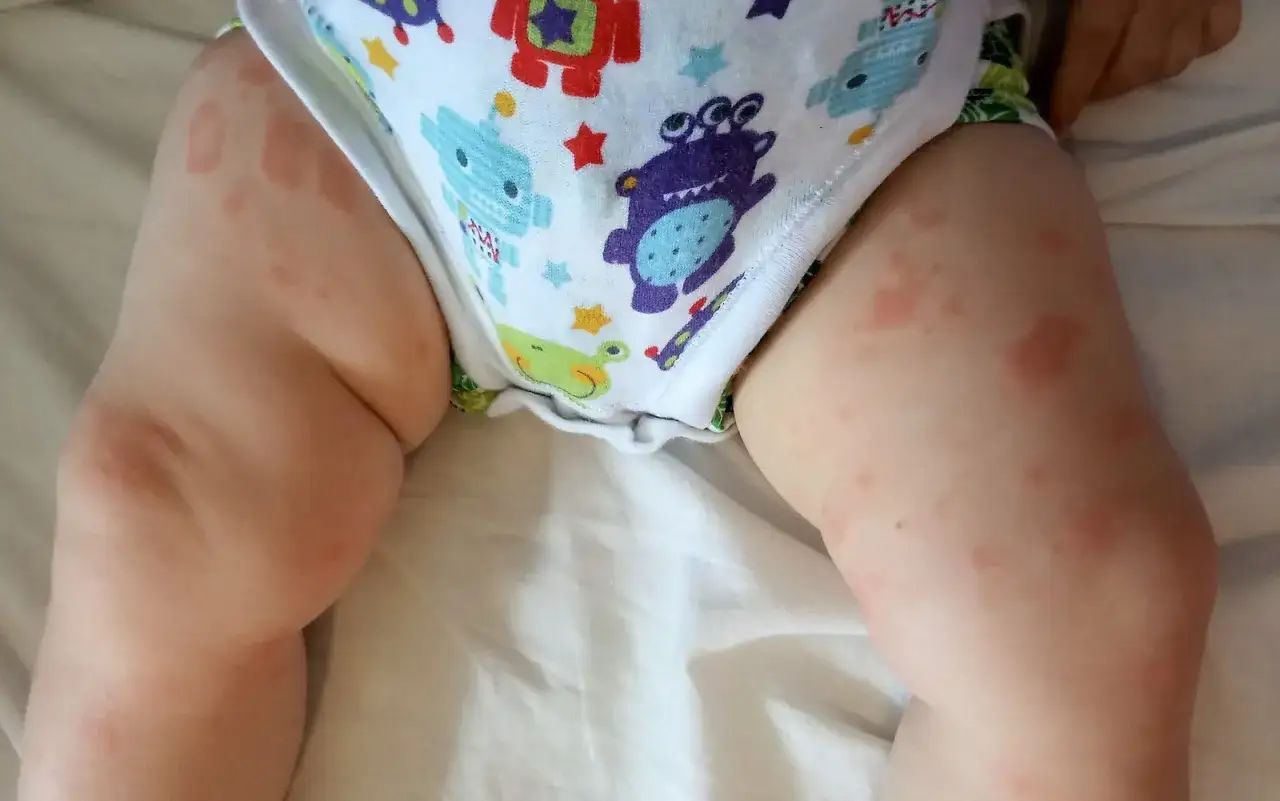 Czerwone plamy na sk&oacute;rze dziecka, widoczne na udach i w okolicy pieluszki, mogą wskazywać na uczulenie na mleko modyfikowane.