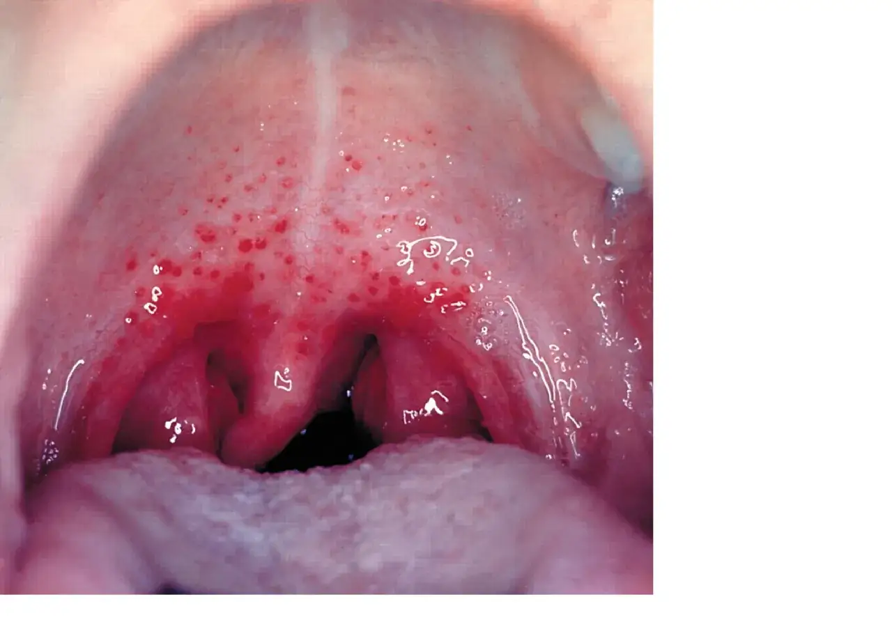 Widoczne zaczerwienienie i drobne kropki na podniebieniu i migdałkach sugerują paciorkowca w gardle.