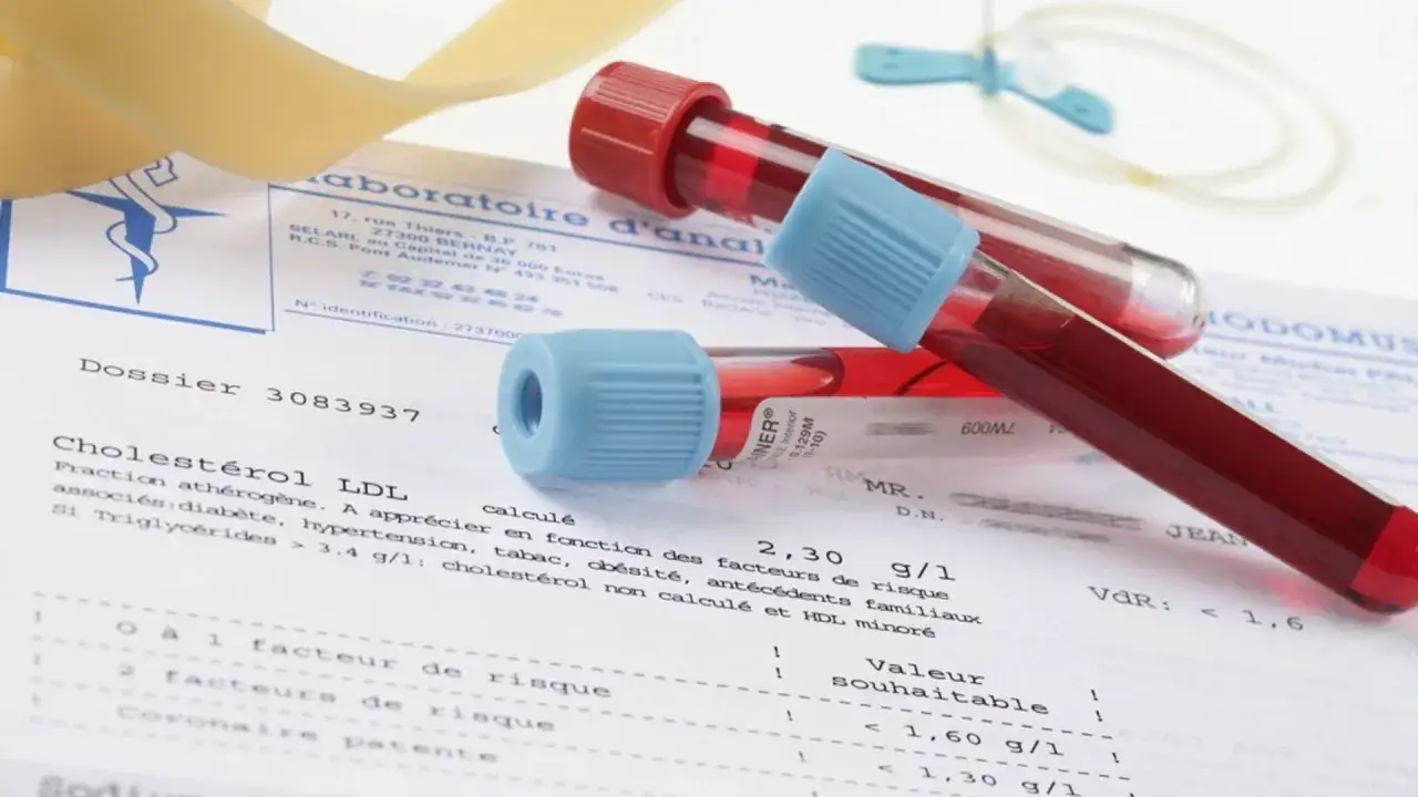 Pr&oacute;bki krwi w prob&oacute;wkach leżą na wynikach badań, gdzie widnieje frakcja LDL. Badanie to pomaga ocenić ryzyko chor&oacute;b serca, a wyniki są kluczowe w diagnostyce. CRP to kolejny wskaźnik stanu zapalnego.
