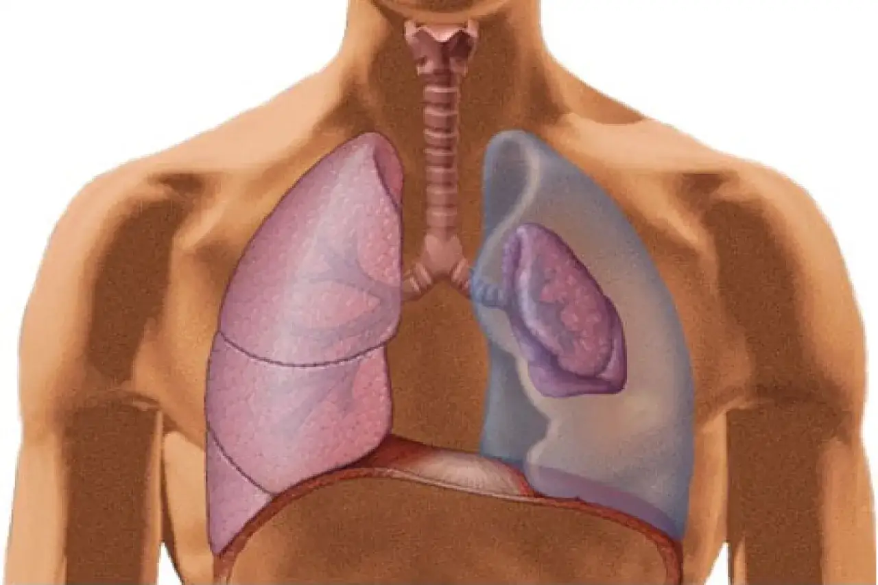 Anatomia płuc z zaznaczoną odmą. Leczenie odmy płucnej trwa r&oacute;żnie, zależnie od jej rozległości.