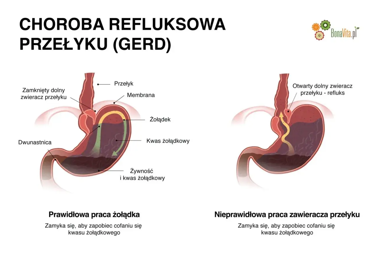 Ilustracja pokazuje prawidłowe i nieprawidłowe działanie zwieracza przełyku, zapobiegające refluksowi. Emanera zdrowia to prawidłowe trawienie.