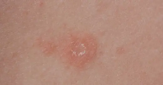 Liszaj twardzinowy - Czy to tylko podrażnienie? Objawy, leczenie, ryzyko