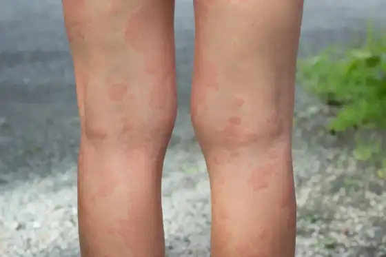 Wysypka na nogach - Czy to zawsze alergia? Rozpoznaj przyczyny