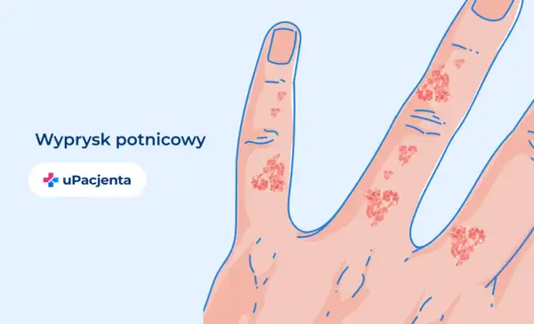 Dłoń z wypryskiem potnicowym. Czy egzema jest wyleczalna? UPacjenta.