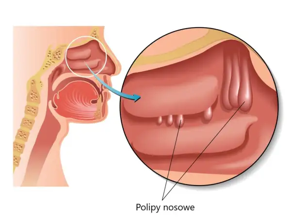 Ilustracja przekroju nosa z widocznymi polipami nosowymi.
