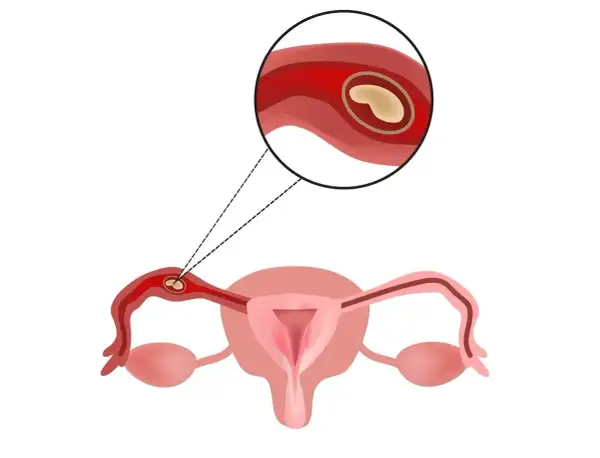 Ilustracja anatomiczna przedstawiająca ciążę pozamaciczną w jajowodzie.