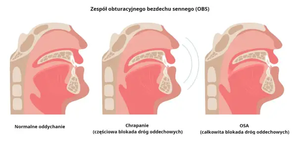 Ilustracja pokazuje przekrój gardła przy normalnym oddychaniu, chrapaniu (częściowa blokada) i bezdechu sennym (OSA, całkowita blokada). Domowe sposoby na bezdech senny mogą pomóc.